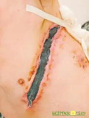 Мужчине вшили настоящую молнию!!!