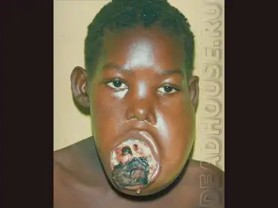 Смерть при жизни - уродство и сифилис.