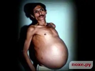 36-летний дядя выносил близнеца!