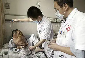 "Человек-слон"