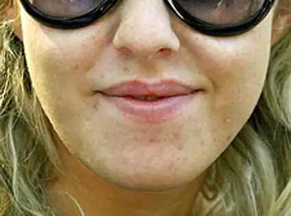 Ксюша Собчак покрывается прыщами