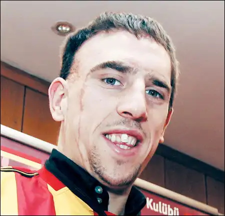 Франк Рибери – человек со шрамом