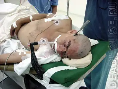 Черепно-Мозговая травма