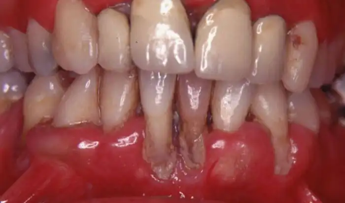 Как лечат стоматит (15 фото)