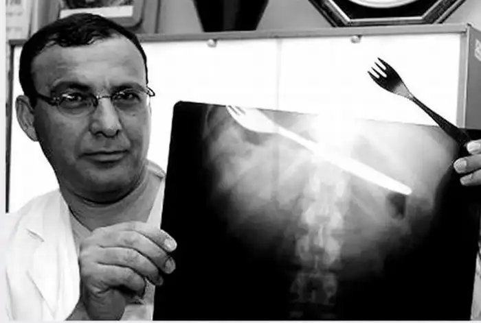 Необычные вещи, найденные внутри людей