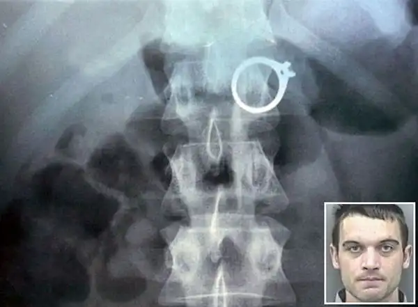 Необычные вещи, найденные внутри людей