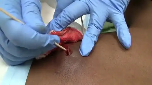 Абсцес на спине