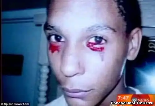 Американский подросток плачет кровью.