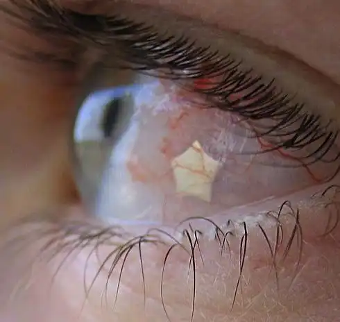 ГЛАЗНОЙ ПИРСИНГ