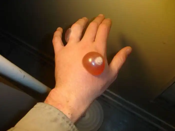 Ожоги от жидкого азота