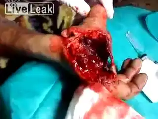 Тяжелая травма руки