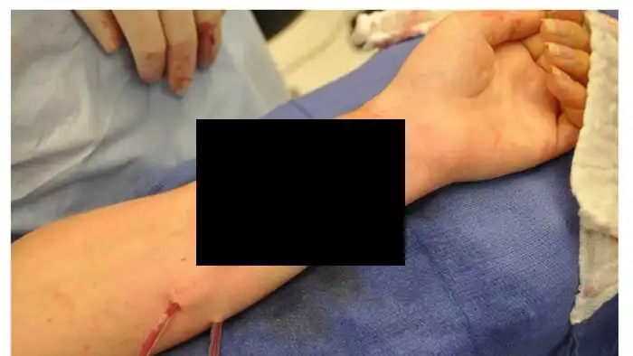 Врачи вырастили ушную раковину на руке женщины