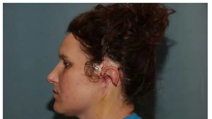 Врачи вырастили ушную раковину на руке женщины