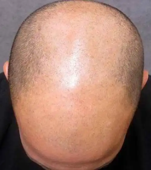 Татуировка, которая скроет мужскую лысину