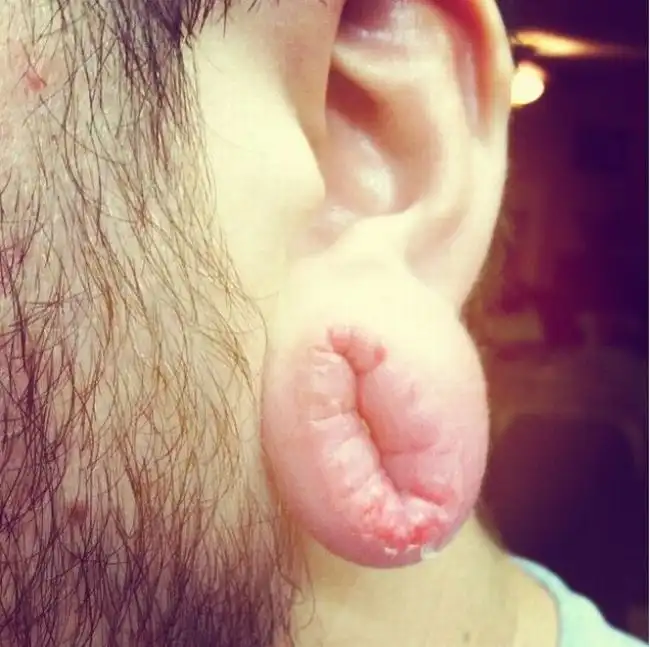 Во что превратятся уши, если извлечь растягивающие тоннели