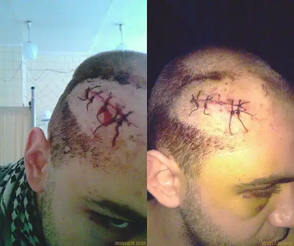 Последствия драк.