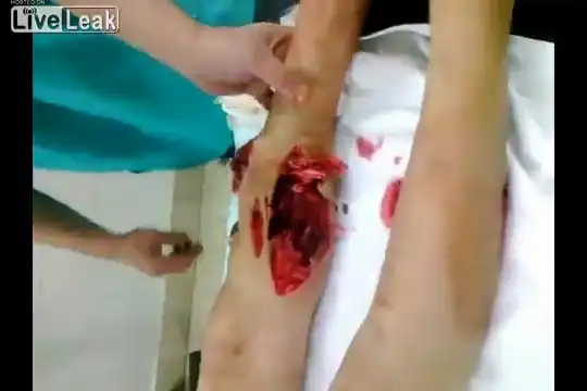 Подросток с простреленной ногой