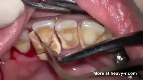 Удаление зубного камня.