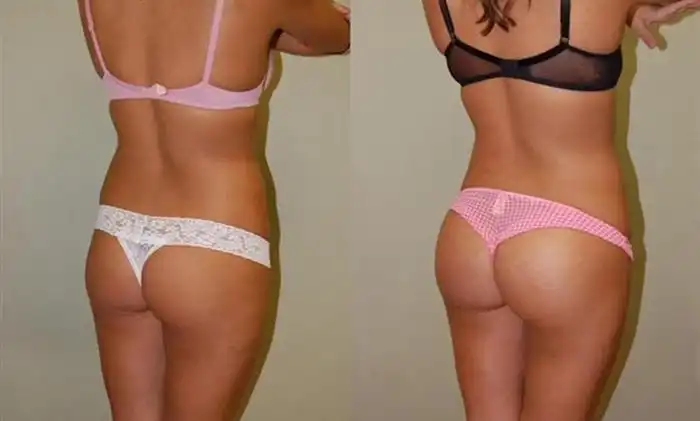 До и после пластических операций по коррекции попы