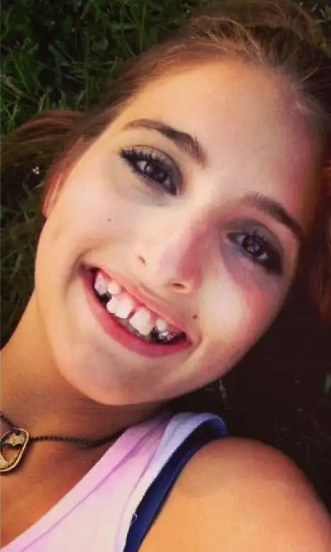 Как изменилась девушка после операции на челюсти