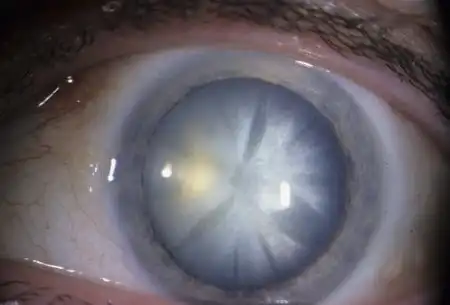 Катаракта как есть.