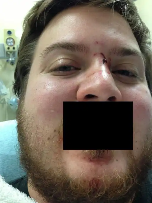 Восстановление губы, откушенной собакой