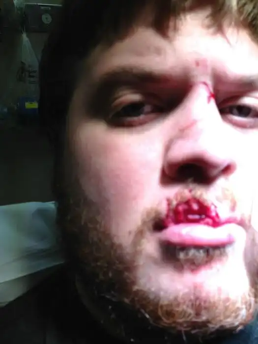 Восстановление губы, откушенной собакой