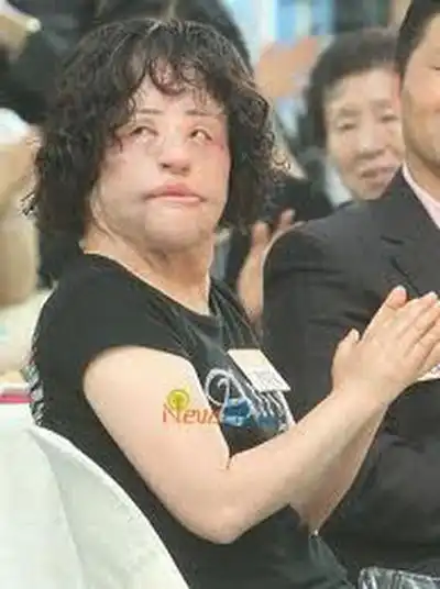 Женщина изуродовала себя, введя себе под кожу растительное масло