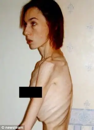 Школьница одержимая диетами превратила себя в ходячий скелет