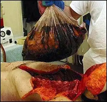 Из-за леса, из-за гор кишки, месиво, хардкор!