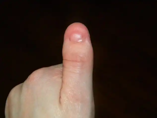 10 редких и странных заболеваний, о которых вы, возможно, не знали