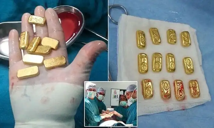 Извлечение золотых слитков из желудка