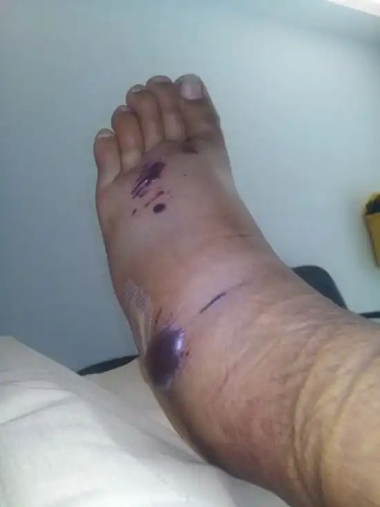 Последствия яда бородавчатки