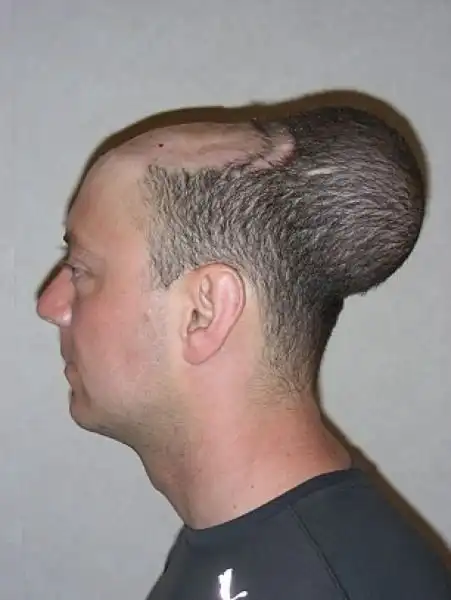 Как мужику надули голову, чтобы избавить от лысины