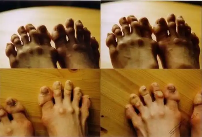 Профессиональный недуг балерин