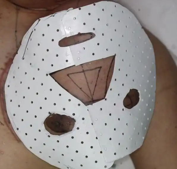 Врачи выращивают новое лицо на груди электрика-неудачника