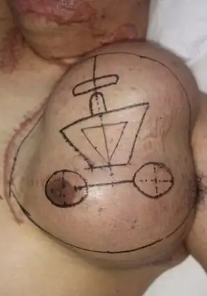 Врачи выращивают новое лицо на груди электрика-неудачника