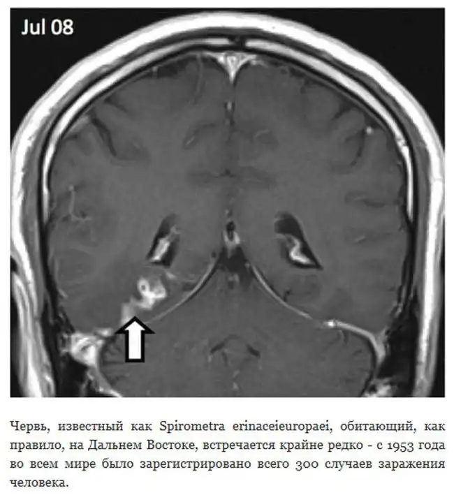Паразитический червь 4 года блуждает по мозгу человека