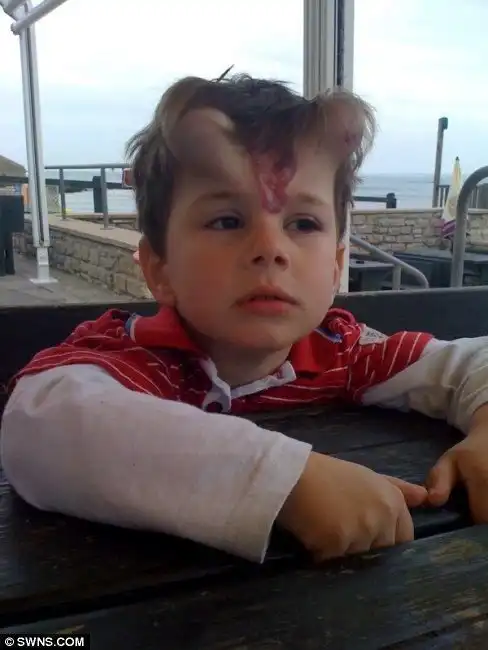 Ребенку вшили под кожу рога, чтобы удалить родимое пятно