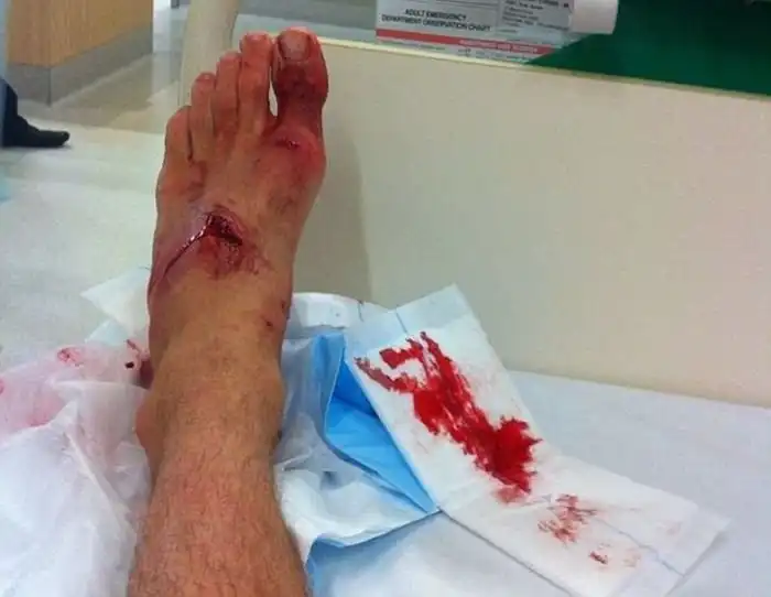 Акула атаковала серфера