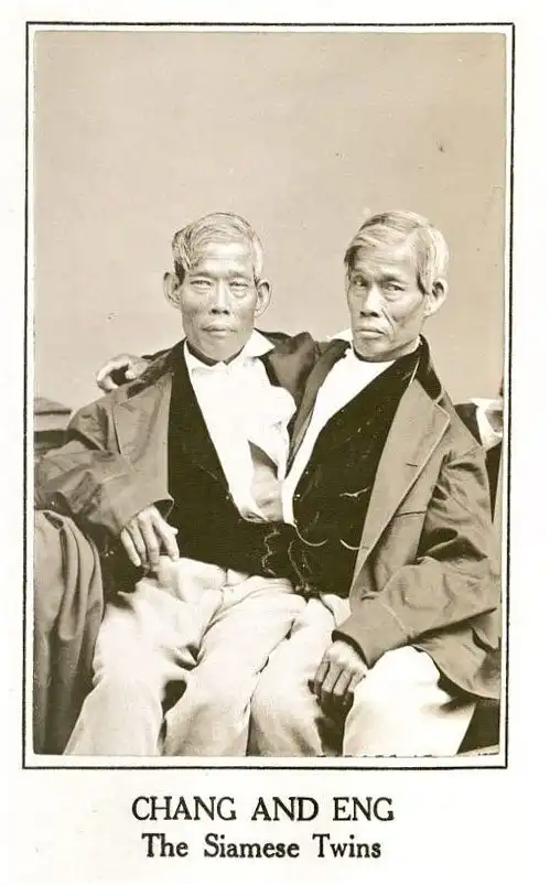 Сиамские близнецы: вместе на всю жизнь