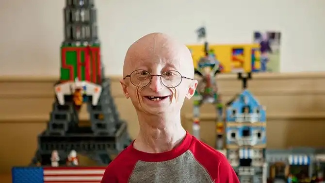 25 самых странных болезней мира, которые ученые до сих пор не могут объяснить