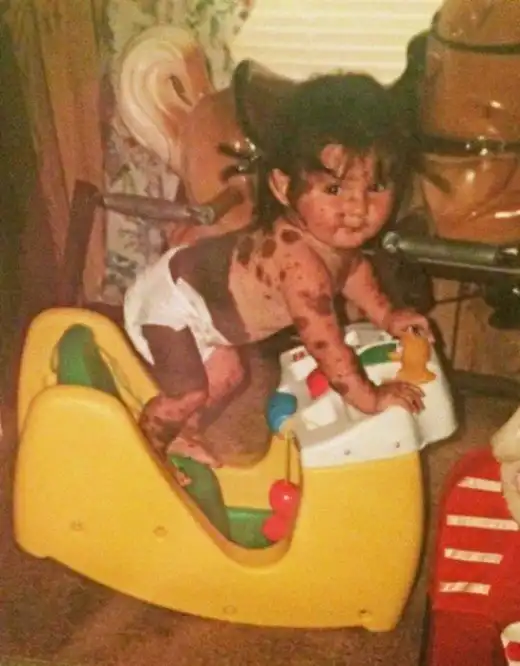 Сиерра Сваринген - девушка с очень редким состоянием кожи