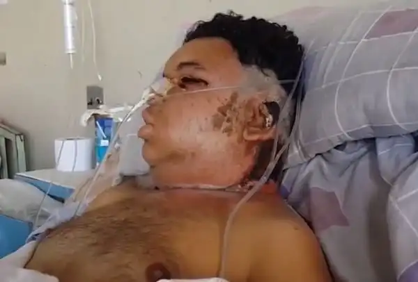 Жертва самого ядовитого в мире паука борется за жизнь в больнице