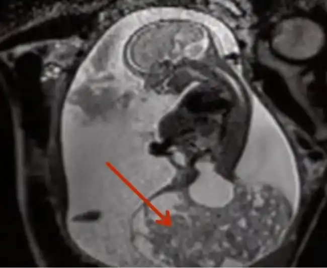 Врачи спасли жизнь еще не родившегося ребенка, избавив его от гигантской опухоли