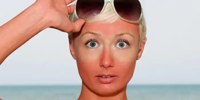 9 способов скрыть следы солнечных ожогов и быстро восстановить кожу
