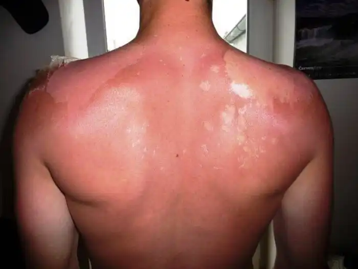 Неожиданные факты про загар и солярии, которые вы могли не знать