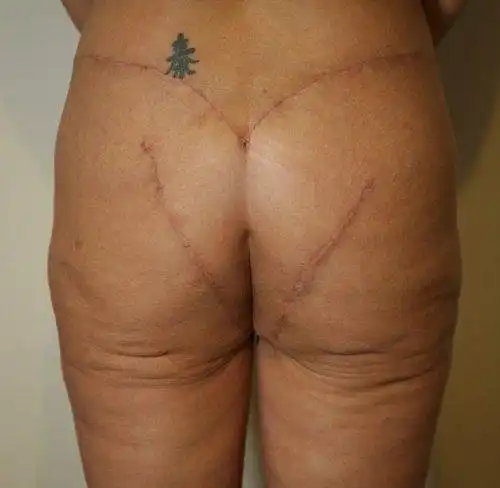 После пластики ягодицы выглядели, как после укуса акулы