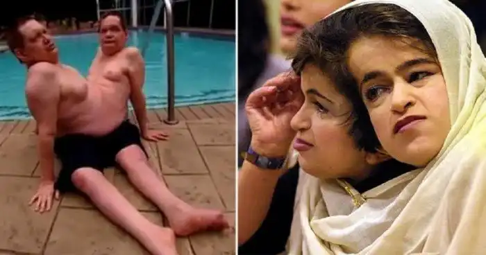 Подлинные истории сиамских близнецов