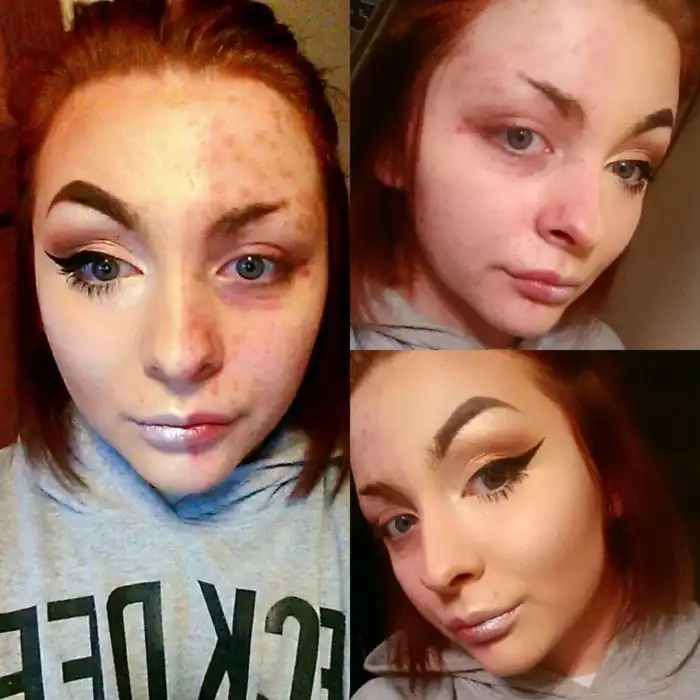 Бьюти-блогера, страдающую псориазом, бросил бойфренд, увидев ее без макияжа